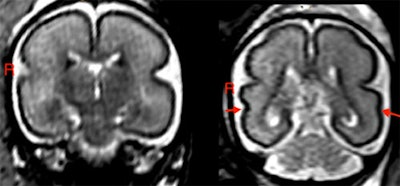 (Left) Fetal brain post-intrauterine alcohol exposure in a fetus between 25 and 29 gestational weeks. Note the smooth cortex in the frontoparietal and temporal lobes. (Right) Brain of matched healthy control case in a fetus between 25 and 28 gestational weeks. The superior temporal sulcus is already bilaterally formed (red arrows) and appears deeper on the right hemisphere than on the left. Image and caption courtesy of the RSNA.