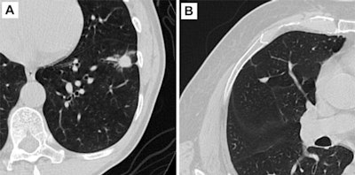 Axial CT images of pulmonary nodules. (A) Malignant nodule. (B) Benign nodule. Image and caption courtesy of the RSNA.