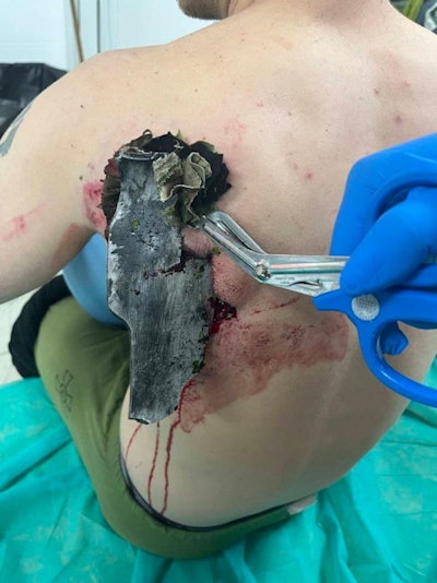 Shell injury, treated by field surgeons alerted by internet communication. Image courtesy of Dr. Yevhenii Nehria.