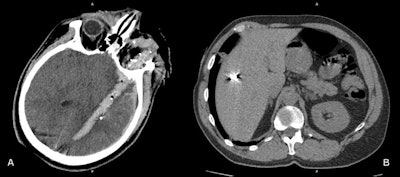 War injuries like these four cases are encountered on a daily basis at Zaporizhia Regional Hospital. (A) Penetrating gunshot wound. The wound channel passes through the left orbit and the left hemisphere of the brain, containing blood, air bubbles. and metal debris. (B) Shrapnel wound of the liver. (C) Gunshot wound of left hemithorax. The wound channel passes through the left lung with contusion of perifocal parenchyma, left pneumothorax, mediastinal and left subcutaneous and intramuscular emphysema. (D) Gunshot wound of left orbit and left maxillary sinus with multiple metal pellets and hemosinus. Images courtesy of Dr. Andrii Makarenkov.