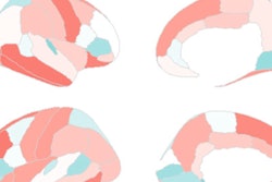 2022 11 22 21 12 8758 2022 11 23 Rsna Pr Adhd 400