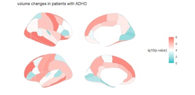 Volume changes in patients with ADHD. Children with ADHD tend to have lower cortical volume, especially in the temporal and frontal lobes. Image and caption courtesy of the RSNA.