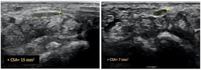 Ultrasound image of median nerve before and after hydrodissection procedure in a patient with carpal tunnel syndrome. This case had cross-sectional area of 12 mm2 pre procedure that reduced to 7 mm2 post procedure (dashed yellow lines depicting the median nerve). Image courtesy of RSNA and Dr. Anupama Tandon.
