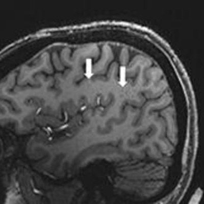 hippocampus mri sagittal