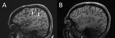 (A) Enlarged centrum semiovale perivascular spaces present (arrows) on sagittal T1-weighted MRI in a case with chronic migraine. (B) MRI shows a migraine-free control case without enlarged spaces. Image and caption courtesy of the RSNA.