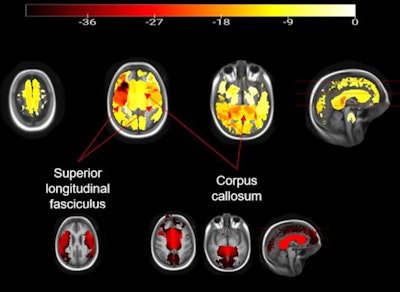 The integrity of the white matter is impaired with higher body mass index (BMI) scores in children, researchers found. The most affected areas include the corpus callosum, which is the main connector of both brain hemispheres, and the superior longitudinal fasciculus that connects several lobes. Images and caption courtesy of the RSNA.