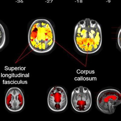 2022 11 23 18 06 7808 2022 11 28 Rsna Brain Mri Children 20221123181416