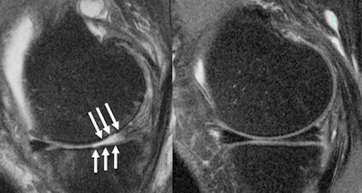 A knee joint of a patient on imaging shows (A) severe cartilage defects and (B) an intact knee joint. Images and caption courtesy of RSNA.