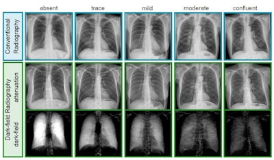 Exemplary radiographs and dark-field chest x-ray images from the study. Image courtesy of Theresa Urban.