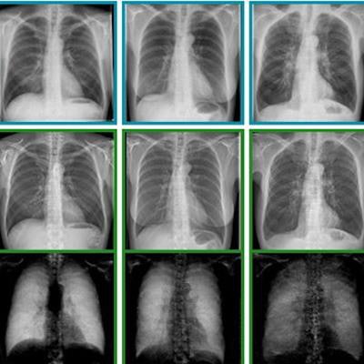 MIBE: RSNA Radiology Podcast - X-Ray Dark-Field Chest Imaging