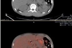 2022 11 28 19 59 4071 2022 11 28 Pet Ai Lymphoma 20221128195352
