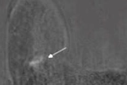 2022 11 29 17 53 1961 2022 11 27 Rsna Breast Mri Dcis 400