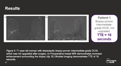 Ultrafast MRI images have potential to predict upstaging of DCIS lesions by measuring time to enhancement (TTE), according to research presented at the RSNA annual meeting. Image courtesy of Dr. Rachel Miceli.