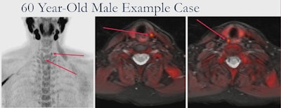 F-18 fluorocholine uptake in parathyroid adenomas in a study participant. Image courtesy of Daniel Thompson.