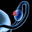 2019 10 15 23 17 6184 Ovarian Cancer 400