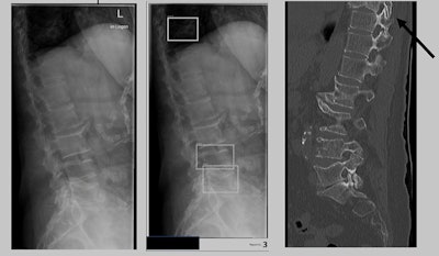 Examples of x-ray images used in the study, with boundary boxes shown by the AI software around areas of suspected vertebral compression fractures. Image courtesy of Jonas Oppenheimer.
