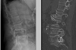 2022 12 01 17 27 9453 2022 12 01 Vertebral Fractures 20221201180007