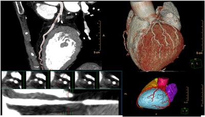 Philips' Advanced Visualization Workspace can provide analysis of cardiac MR images. Image courtesy of Philips.