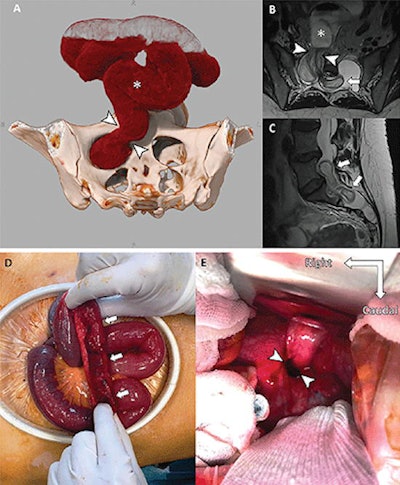 Images of a 38-year-old woman with Marfan syndrome who was diagnosed with intradural small bowel herniation through a torn right S1 dural ectasia. (A) Oblique global illumination rendering of abdominal CT scan after semiautomatic segmentation of the enlarged afferent small bowel (*). The hernia orifice (arrowheads) separates the peritoneal cavity and the intradural space. (B, C) T2-weighted MRI scans in (B) axial and (C) sagittal planes show the herniated loop (arrowheads in B) of small bowel (* in B) ascending at L5-S1 (arrows), causing significant compression of the adjacent cauda equina nerve roots. Image courtesy of Radiology.
