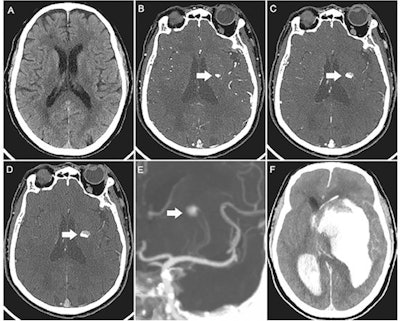 Images of a 73-year-old man with acute left-sided weakness. (A) Axial noncontrast CT image of the head shows no intracerebral hemorrhage. (B) Arterial phase CT angiogram obtained 192 seconds later, after administration of contrast material, demonstrates focal enhancement in the left basal ganglia (arrow). (C, D) CT angiograms obtained in the (C) second and (D) third phases, with delays of 39 seconds and 38 seconds, respectively, highlight the active expansion of the intracerebral hemorrhage with the blood-contrast level (arrows). (E) Coronal maximum intensity projection image reveals that the bleeding was located near the distal ends of the lenticulostriate arteries (arrow). (F) Follow-up noncontrast CT image obtained 1 hour after the third phase CT angiogram shows massive enlargement of the hematoma, intraventricular hemorrhage, hydrocephalus, and subfalcine herniation. Image courtesy of Radiology.