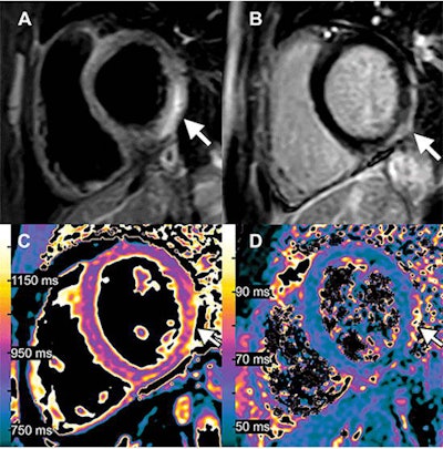 Images of a 15-year-old boy with myocarditis after COVID-19 vaccination. One day after receiving his second vaccination dose, he developed fever, myalgia, and intermittent tachycardia. (A) T2-weighted short inversion time inversion recovery MRI scan at 1.5 T in short-axis view shows focal high-signal intensities (arrow) at basal lateral and inferior wall, indicating myocardial edema. (B) Late gadolinium enhancement image in short-axis view shows corresponding linear subepicardial enhancement (arrow), indicating inflammatory myocardial necrosis. (C) T1 mapping and (D) T2 mapping in short-axis view show elevated T1 and T2 at the mid ventricular lateral and inferolateral wall (arrow in C and D), indicating acute myocardial injury (focal T1, 1165 msec; focal T2, 70 msec; institution-specific cutoff values for acute myocarditis: T1 global ≥1000 msec, T2 global ≥55.9 msec). Image courtesy of Radiology.