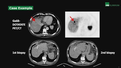A case from the study showing uptake of the somatostatin receptor (SSR) radiotracer Ga-68 DOTATATE in a metastatic neuroendocrine liver tumor. Image courtesy of Dr. Matthias Fabritius.