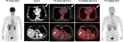 An 80-year-old woman underwent contrast-enhanced CT (CECT) for a recently diagnosed breast tumor before surgery. CECT revealed gallbladder wall thickening with gallstones and a contrast enhancement effect, in addition to a left mammary mass, which may indicate gallbladder cancer. F-18 FDG-PET/CT showed a local increase in accumulation in the gallbladder wall (SUVmax, 8.1), making it difficult to differentiate gallbladder cancer from cholecystitis. F-18 FBPA-PET/CT showed accumulation in the left breast mass (SUVmax, 4.5), but no significant accumulation in the gallbladder wall (SUVmax, 2.8). Cholecystectomy was performed and the pathological diagnosis was inflammatory granulation tissue. Image courtesy of Annals in Nuclear Medicine.
