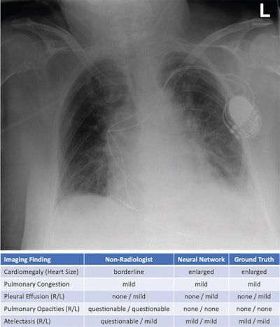 Exemplary bedside chest radiograph in which the initial grading of specific imaging findings by the physicians in the intensive care unit (nonradiologist) was not aligned with the grading by the experienced radiologists (majority vote) in an 85-year-old woman after pacemaker implantation for atrioventricular block 3. L = left patient side, R = right patient side. Image courtesy of Radiology.