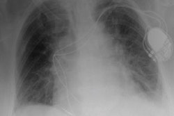 2022 12 09 18 07 3411 2022 12 09 Ai Chest X Ray 20221209180845