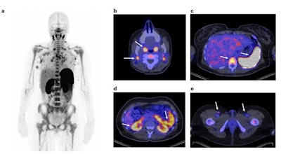 PET tracer reveals dynamics of immunotherapy | AuntMinnie