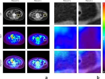 Representative images of (a) F-18 FDG uptake of visceral adipose tissue (VAT) according to the breast cancer recurrence status and (b) their corresponding magnified views. Image and caption courtesy of Scientific Reports licensed under CC BY 4.0 International License.