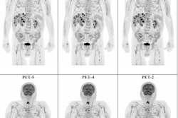 2022 12 14 23 27 8087 2022 12 13 Pet Ct Melanoma 20221214231654