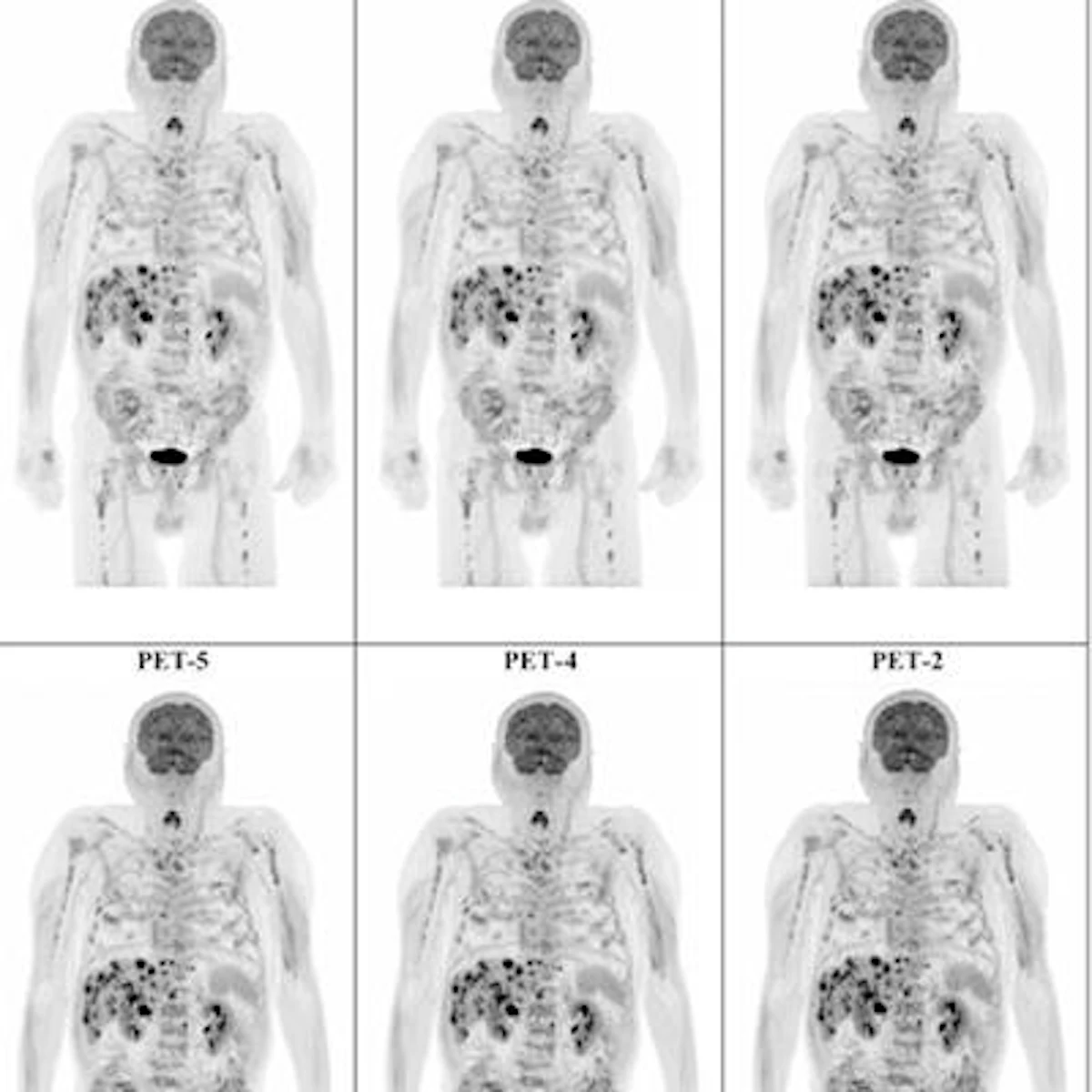 Whole-body PET/CT cuts scan time in melanoma patients | AuntMinnie