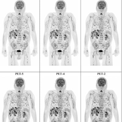 2022 12 14 23 27 8087 2022 12 13 Pet Ct Melanoma 20221214231654