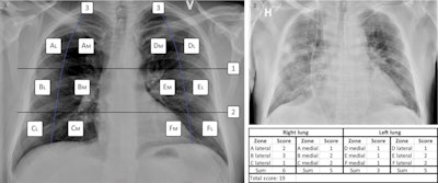 (A) The MBrixia scoring system. Box 1 and 2 mark the horizontal division corresponding to the inferior wall of the aortic wall, and the inferior wall of the right pulmonary vein, respectively, creating three zones in each lung: A, B, C, D, E and F. Box 3 marks the vertical line drawn from the pulmonary apices to the diaphragm, creating further division into medial (M) and lateral (L) zones. (B) A clinical example of a chest x-ray image scored using the MBrixia score. Image courtesy of Scientific Reports through CC BY 4.0 International License.