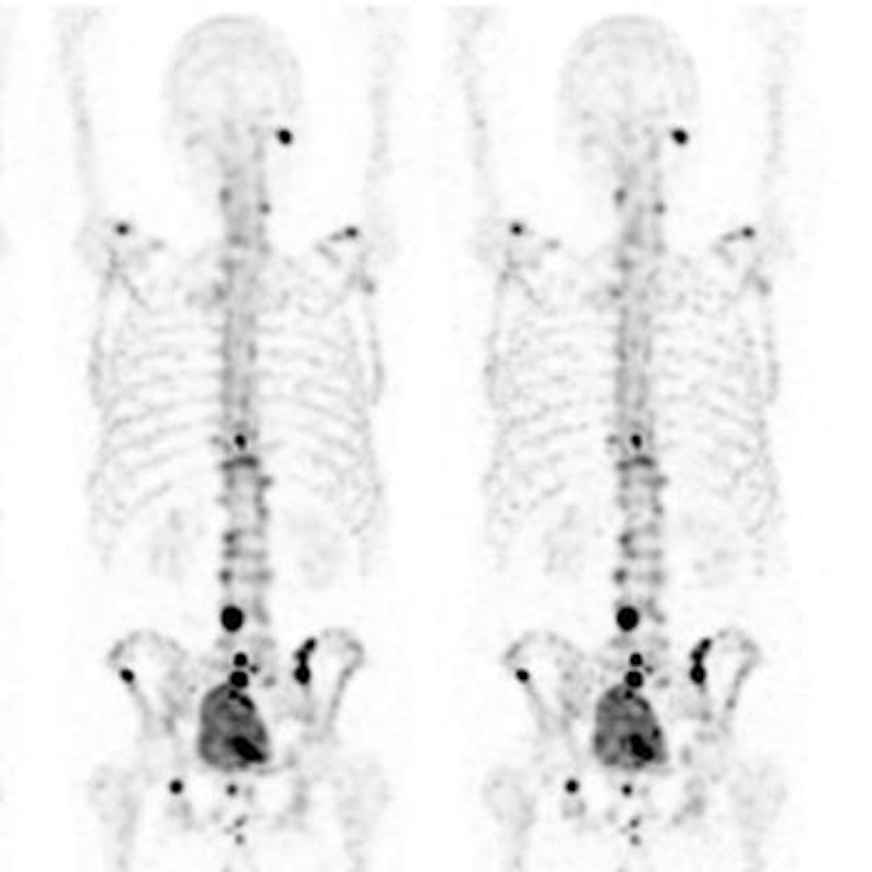Fast acquisition techniques cut SPECT/CT bone scan times by half ...