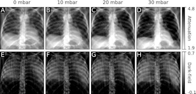 Conventional (upper row) and dark-field (lower row) radiographs of the first inflation cycle at (A, E) 0.0 kPa (0.0 psi), (B, F) 1.0 kPa (0.15 psi), (C, G) 2.0 kPa (0.29 psi), and (D, H) 3.0 kPa (0.44 psi). For both imaging modalities, greater lung volume can be observed with higher pressure. Attenuation signal of the lung visually decreases with higher pressure levels, while dark-field signal increases. Image courtesy of Radiology: Cardiothoracic Imaging.