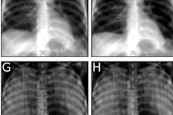 2022 12 20 00 20 9869 2022 12 19 Dark Field Chest X Ray Lung Pressure 20221220005120