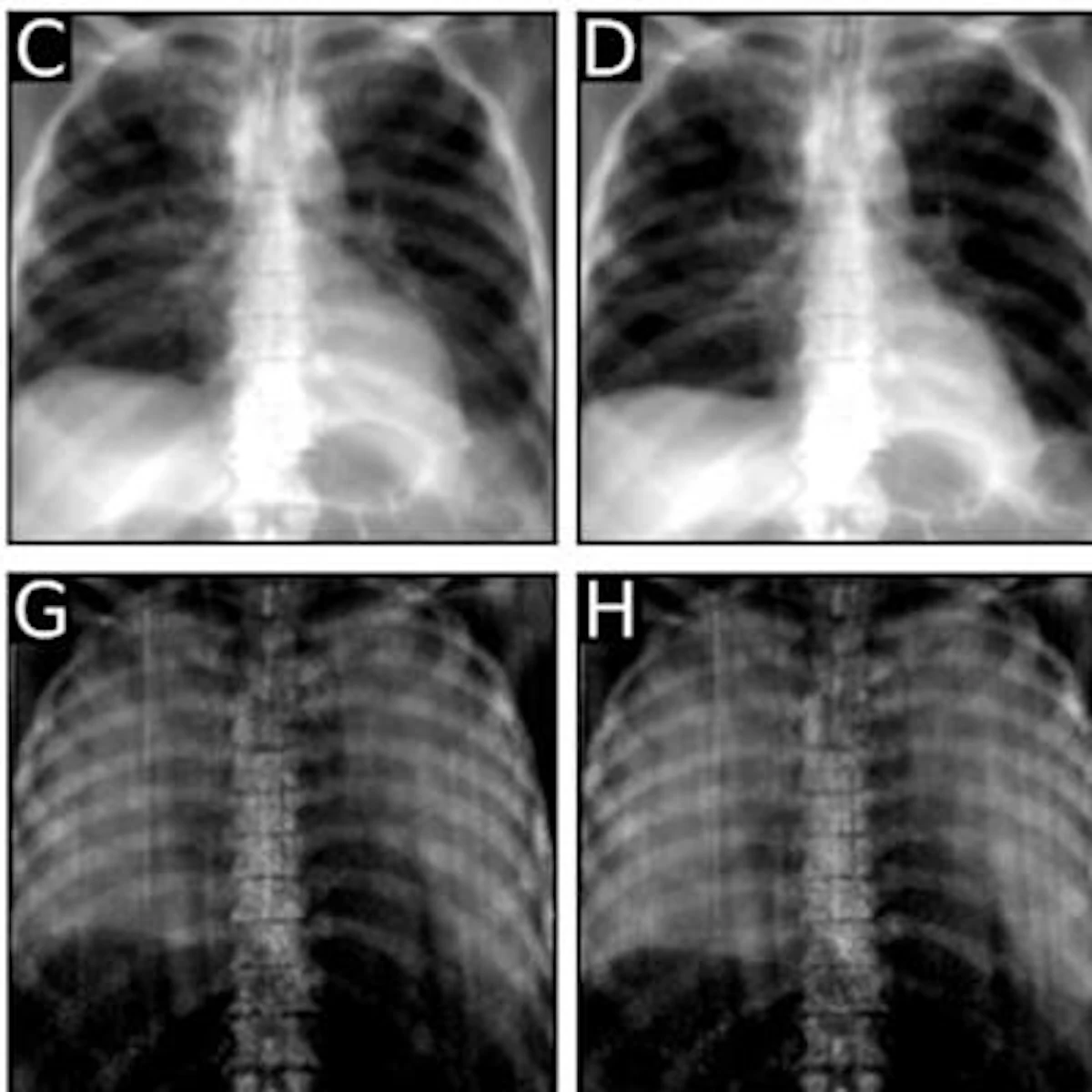 Dark-field chest x-ray picks up lung inflation signals | AuntMinnie