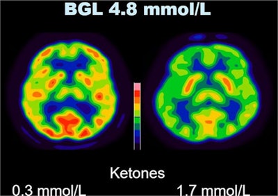 Effect of serum ketone level on cerebral SUVbw. Sample images of two patients thresholded identically with the same blood glucose level, but different serum ketone levels illustrate the reduction in FDG uptake in the brain seen with a higher serum ketone level. Image courtesy of the European Journal of Hybrid Imaging through CC BY 4.0 International License.
