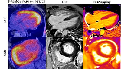 Increased Ga-68 FAPI-04 uptake corresponds to the accumulation of FAP+-expressing myofibroblasts in myocardial biopsy. Representative image of a Ga-68 FAPI-04-PET/CT scan and the corresponding image of cardiac MRI with late gadolinium enhancement (LGE) and T1-mapping of a patient with myocardial fibrosis (MF). Image courtesy of the European Journal of Nuclear Medicine and Molecular Imaging though CC BY 4.0 International License.