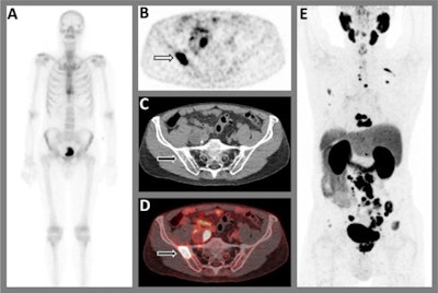 A 75-year-old patient with biopsy-proven prostate cancer. (A) Tc-99m bone scintigraphy axial images show increased bone activity in two thoracic vertebrae (Th9 and Th10) that were classified as (osteoporotic) compression fractures, and the faint uptake in the left third rib was attributed to a post-traumatic origin. Although there was a clear high-risk profile in this patient, there was no suspicion for bone metastases. (B) transversal reconstruction of F-18 PSMA-PET at pelvic region, (C) CT and (D) fused PET/CT images show a suspicion for a bone metastasis in the right iliac bone, in contrast to the bone scintigraphy. Moreover, an extensive suspicion for lymphogenous and osseous metastatic lesions were found throughout the body, as shown on (E) PET axial images. Based on the F-18 PSMA-PET/CT results, the patient was treated with androgen deprivation therapy in combination with abiraterone. Image and caption courtesy of Urologic Oncology and licensed under CC BY 4.0