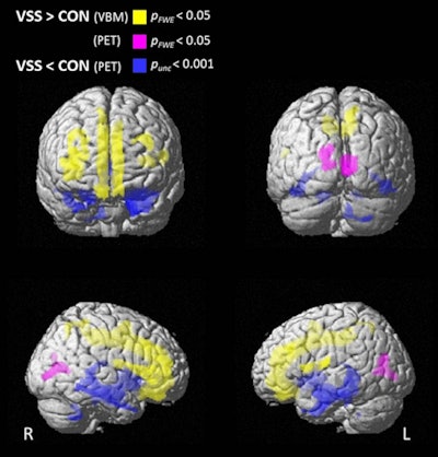 Differences in brain gray matter volume, voxel-based morphometry (VBM), and glucose metabolism (PET) between patients with visual snow syndrome (VSS) and controls. Surface rendering showing brain regions with increased gray matter volume (yellow), increased glucose metabolism (purple) (pFWE,