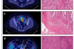 2023 01 09 21 32 2541 2023 01 09 Ai Endometrial Cancer 400