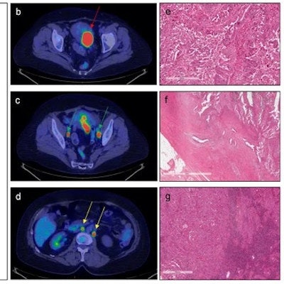 2023 01 09 21 32 2541 2023 01 09 Ai Endometrial Cancer 400