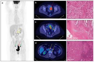 A 71-year-old patient with endometrial cancer who underwent F-18 FDG-PET/CT for staging purposes. Red arrows indicate pathological uptake in correspondence of the primary tumor. Green arrows indicate pathological uptake in correspondence of bilateral iliac-obturator lymph nodes, and yellow arrows indicate pathological uptake in correspondence of lomboaortic and interaortocaval lymph nodes [(a): Maximum intensity projection; (b–d): transaxial PET/CT images]. PET parameters of the primary tumor were as follows: SUVmax = 17.43; SUVmean = 11.82; MTV = 28.60; TLG = 338.04. Histological analysis: the tumor is constituted by large cells with a high grade of nuclear atypia and numerous mitotic figures (e). The tumoral growth is mainly in papillary projections. Myometrial infiltration (f) has a tubulo-glandular architecture with micropapillary structure into the lumen; the way of myometrial invasion is infiltrative/destructive. Lymph nodal metastasis (g) is nodular and constituted by serous atypical cells arranged in cords and small nests. Image and caption courtesy of Cancers and licensed under CC BY 4.0.