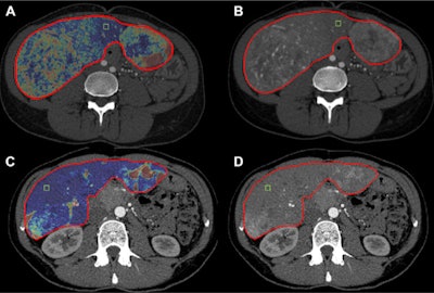 Changes in liver-enhancing tumor burden (LETB) in a 36-year-old woman with pancreatic neuroendocrine liver metastases treated with transarterial chemoembolization. (A, B) Pretreatment CT showed a total hepatic volume of 2823 cm3, a volume of enhancing tumor of 1035 cm3, and a LETB of 36.6%. (C, D) Post-treatment CT showed a total hepatic volume of 1607 cm3, a volume of enhancing tumor of 354 cm3, and an LETB of 22%. LETB dropped by 41%. Hepatic and whole-body progression-free survivals were each 11 months, and overall survival was 21 months. Note: The segmentation mask to determine the whole-liver volume is shown as the red borders of the liver. The green box represents the 0.5 cm3 region of interest placed in the nontumoral liver parenchyma to quantify the LETB. Images and caption courtesy of the RSNA.