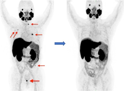 A maximum intensity projection image showing the presence of anomalous F-18 PSMA-1007 concentration in the pelvic cavity, suggesting local recurrence of prostate cancer (left, thick arrow), local bones metastasis on pretreatment examination (left, thin arrows), and their absence on post-treatment (stereotactic and androgen deprivation therapy) examination (right). Image courtesy of Research in Diagnostic and Interventional Imaging through CC BY 4.0 International License.