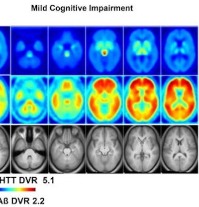 Brain PET scan