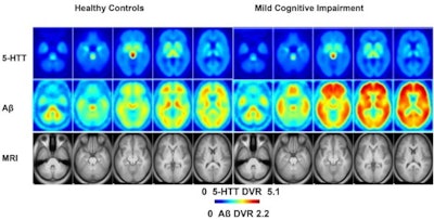 PET scans of 5-HTT and beta amyloid in healthy controls and individuals with MCI. Mean distribution volume ratio images of healthy controls (left panels) and MCI (right panels) and an MRI template (bottom panel). Image courtesy of NeuroImage: Clinical through CC BY 4.0.